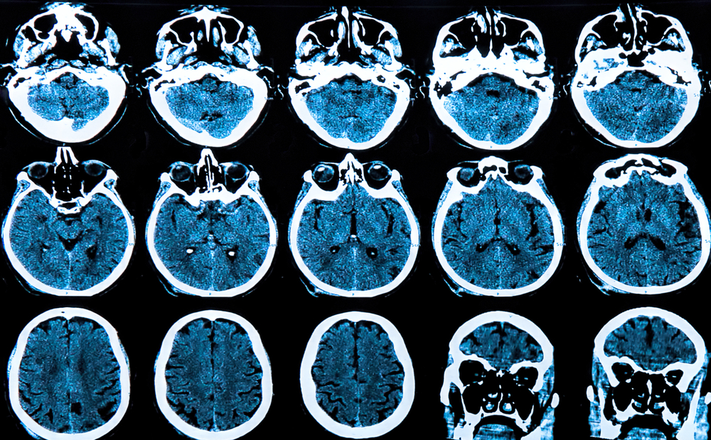 CLEC16A: The gene at the crossroads of immunity and neurodegeneration