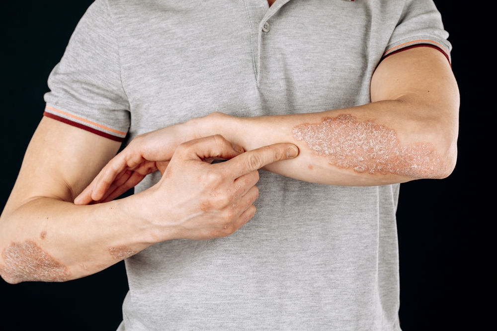 Psoriasis Is More Than Skin Deep: Systemic Inflammation and Comorbidities