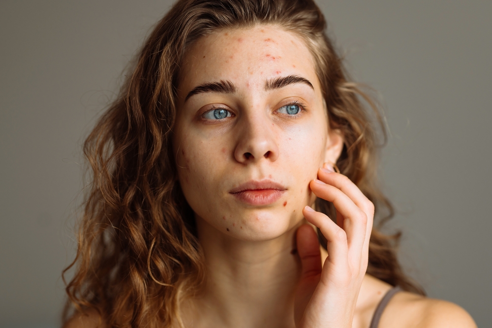 Young woman with acne